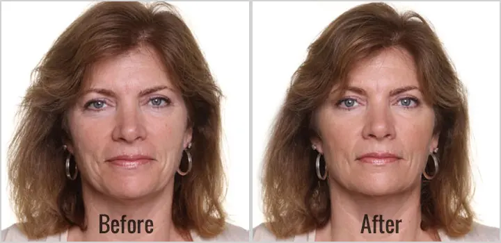 tratamente intraceuticals oxigen pete pigmentare 11
