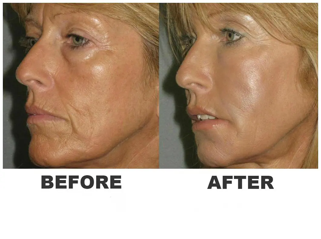 tratamente radiofrecventa antirid faciale 3