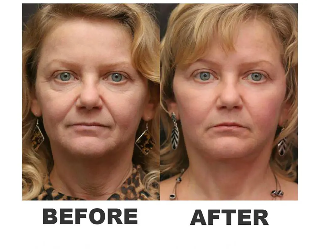 tratamente radiofrecventa antirid faciale 4