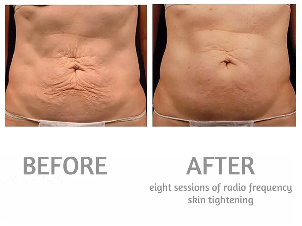 tratamente radiofrecventa electrostimulare corporala 3
